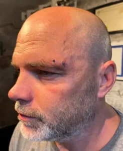 Homme dans la mi-quarantaine au crâne rasé a eu un excellent surface piercing prix tout en venant de se faire percer un Surface EyeBrow Piercing au sourcil par Yan Dubord et possède un beau bijou avec deux plaques couleurs argent en Titanium.