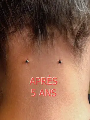 Meilleure idée de piercing microdermal côté durabilité car ces deux implants microdermals derrière la tête dans la nuque sous le cuir chevelu sont les ayant la plus vie que j'ai vue.