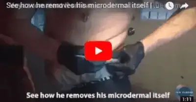 Thumbnail d'une vidéo Youtube invitant les internautes à cliquer pour voir le vidéos et ainsi donner l'idée de comment enlever son piercing microdermal.